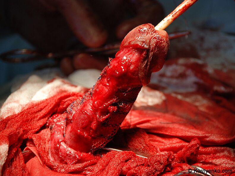 placement of a collagen matrix for penis enlargement