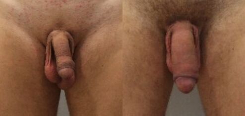 before and after penile enlargement surgery