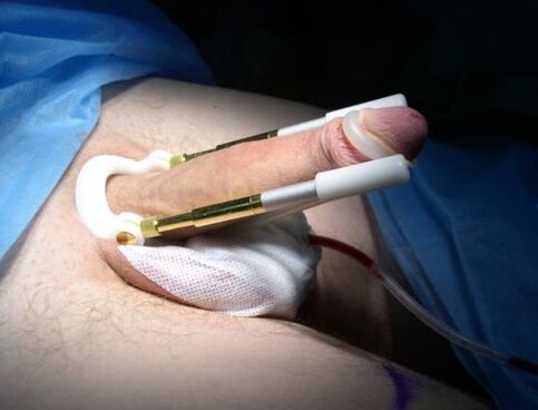 wearing an extender after penile enlargement surgery