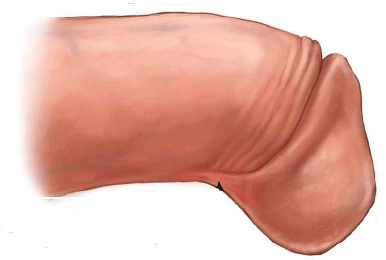 how to enlarge penis head